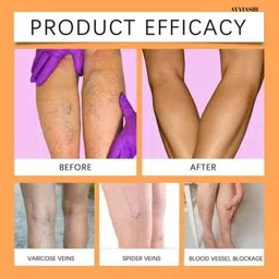 ayyiashi Varicose Veins Spray Effective Herbal Treatment For Vein Care Liquid image 5