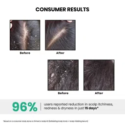 ThriveCo AHA BHA PHA Exfoliating Scalp Scrub | Promotes Hair Growth, Clears Dandruff, Dead Skin, Oil & Product Buildup | Works on Dry, Flaky & Itchy Scalp | For Men & Women | Travel-Friendly | 25ml image 4